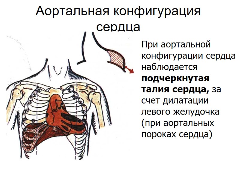 Аортальная конфигурация сердца При аортальной конфигурации сердца наблюдается подчеркнутая талия сердца, за счет дилатации